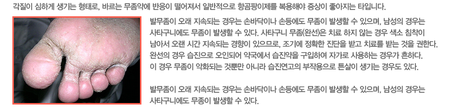 ������ ���ϰ� ����� ���·�, �ٸ��� �����࿡ ������ �������� �Ϲ������� �װ��������� �����ؾ� ������ �������� Ÿ�Դϴ�.�߹����� ���� ���ӵǴ� ���� �չٴ��̳� �յ�� ������ �߻��� �� ������, ������ ���� ��Ÿ���Ͽ��� ������ �߻��� �� �ִ�. ��Ÿ���� ����(�ϼ�)�� ġ�� ���� �ʴ� ��� ���� ħ���� ���Ƽ� ���� �ð� ���ӵǴ� ������ �����Ƿ�, ���⿡ ��Ȯ�� ������ �ް� ġ�Ḧ �޴� ���� ���Ѵ�. �ϼ��� ��� �������� ���εǾ� �౹���� �������� �����Ͽ� �ڰ��� ����ϴ� ��찡 ���ϴ�. �� ��� ������ ��ȭ�Ǵ� �ͻӸ� �ƴ϶� ���������� ���ۿ����� ư���� ����� ��쵵 �ִ�. �߹����� ���� ���ӵǴ� ���� �չٴ��̳� �յ�� ������ �߻��� �� ������, ������ ���� ��Ÿ���Ͽ��� ������ �߻��� �� �ִ�.