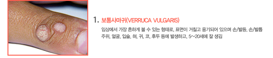 1.����縶��(Verruca Vulgaris)�ӻ󿡼� ���� ���ϰ� �� �� �ִ� ���·�, ǥ���� ��ĥ�� ����Ǿ� ������ ��/�ߵ�, ��/���� ����, ��, �Լ�, ��, ��, ��, �ĵ� � �߻��ϰ�, 5~20���� �� ����