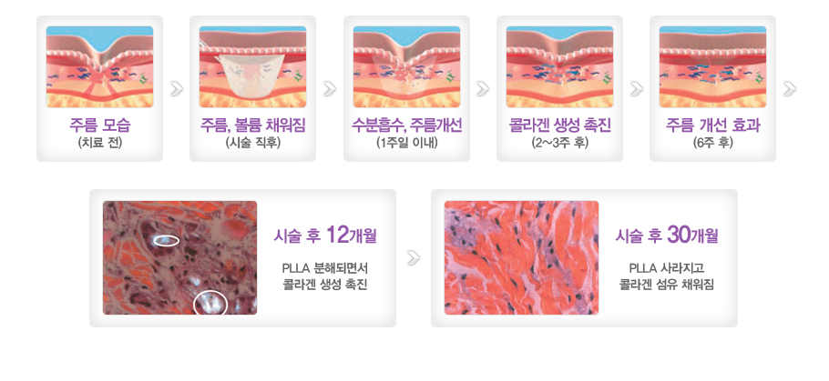 �ָ� ���(ġ����)���ָ�,���� ä����(�ü� ����)���������,�ָ�����(1���� �̳�)���ݶ�� ���� ����(2~3�� ��)���ָ� ���� ȿ��(6�� ��)��ü� �� 12����(PLLA ���صǸ鼭 �ݶ�� ���� ����)��ü� �� 30���� (PLLA ������� �ݶ�� ���� ä����)